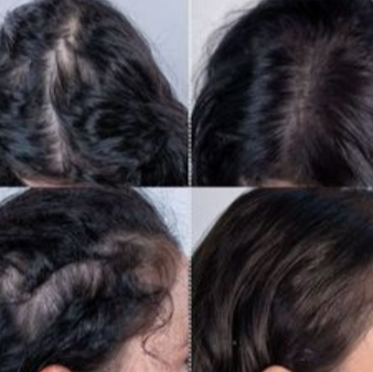 SER ANTICADERE PAR CU 5% MINOXIDIL, BIOTINA SI GHIMBIR