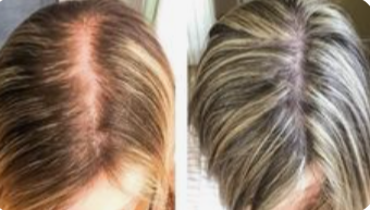 SER ANTICADERE PAR CU 5% MINOXIDIL, BIOTINA SI GHIMBIR