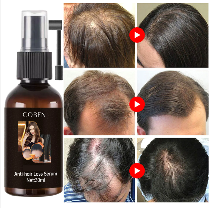 SER ANTICADERE PAR CU 5% MINOXIDIL, BIOTINA SI GHIMBIR