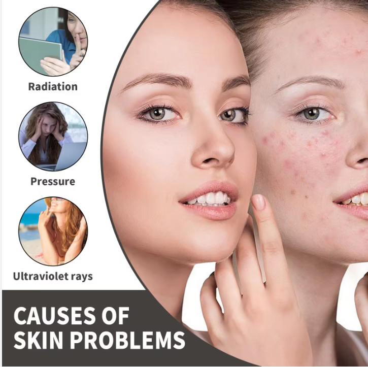 CREMA LĂPTOASĂ HIDRATANTĂ DE FAȚĂ PENTRU REPARAREA URMELOR ACNEICE 30ML